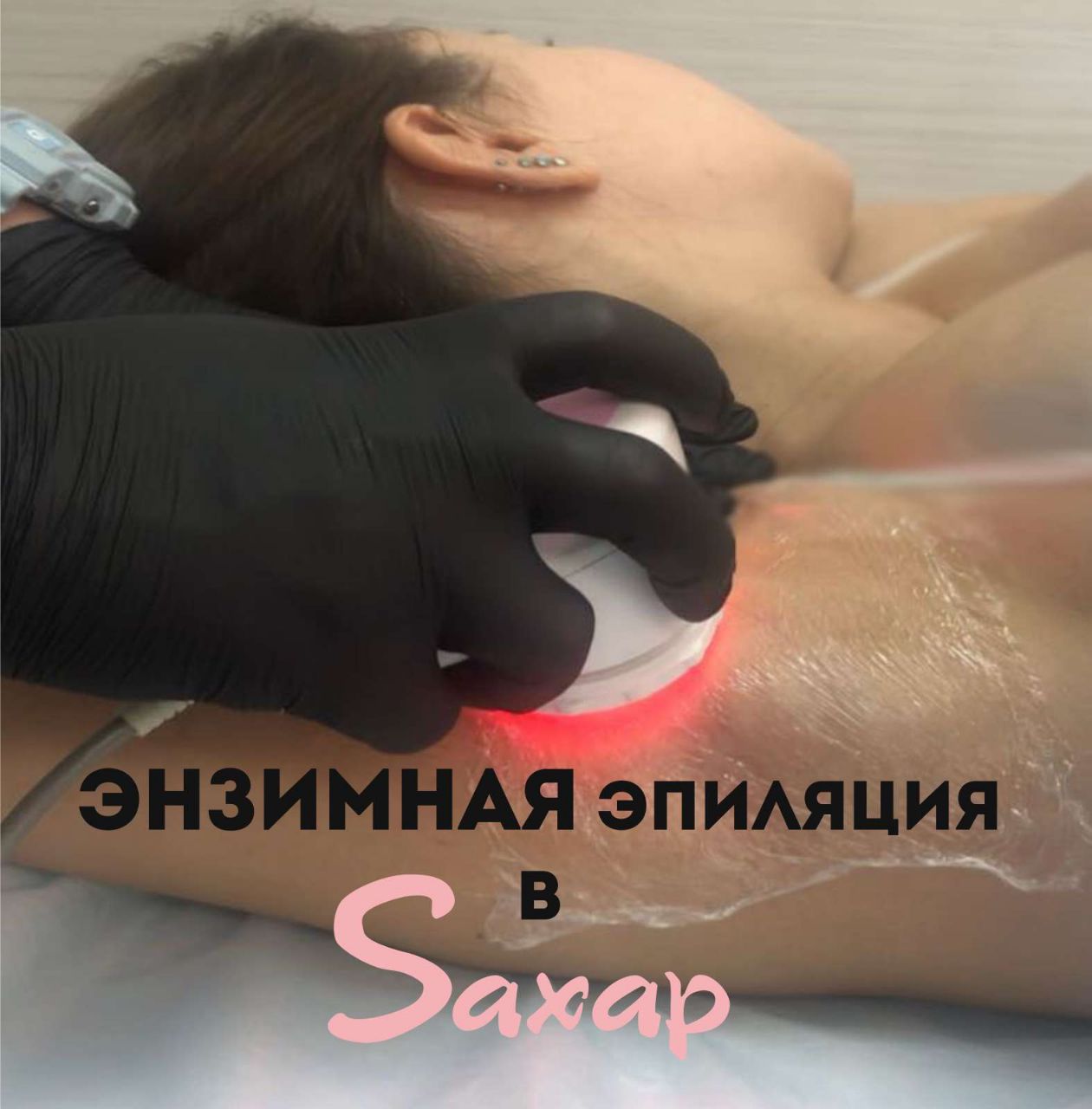 Энзимная эпиляция